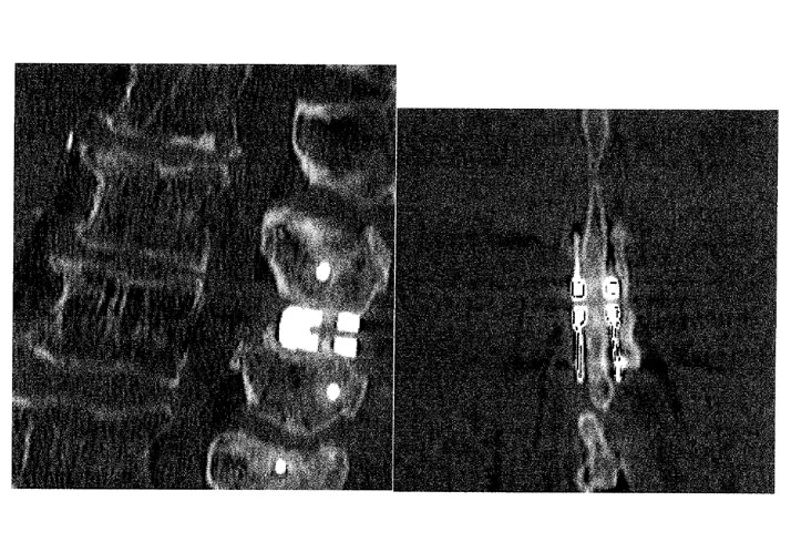 Tac-lombosacrale-eseguita-a-6-mesi-dal-intervento-chirurgico Tac lombosacrale eseguita a 6 mesi dall’intervento chirurgico