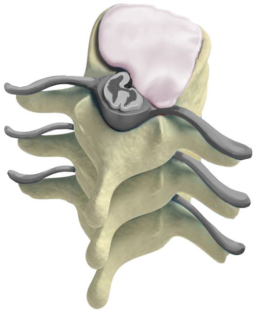 discectomia e rimozione di ernia fibricalcifica