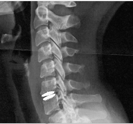 discectomia-rimozione-ernia-fibrocalcifica