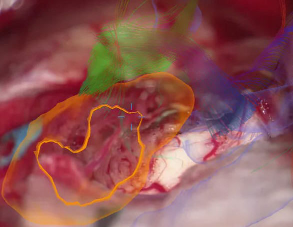 tecnologie applicate neurochirurgia