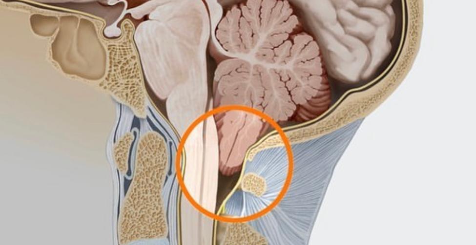 sindrome-arnold-chiari trattamento sindrome Arnold Chiari
