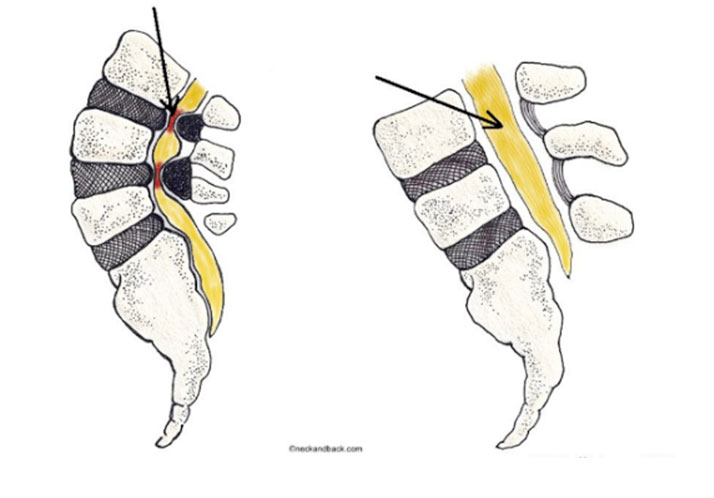 stenosi del canale lombare stenosi del canale lombare